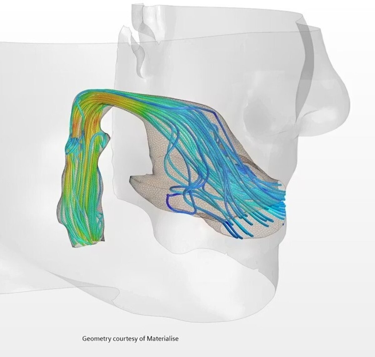 Drug Delivery Simcenter STAR CCM